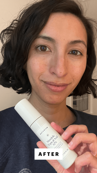 Pai after applying the Naturium Mandelic Topical Acid 12